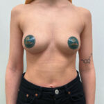 Маммопластика увеличение - после