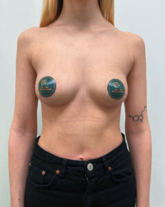 Маммопластика увеличение - после