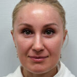 Эндоскопический лифтинг с нижней блефаропластикой и липофилингом в область верхних век - после