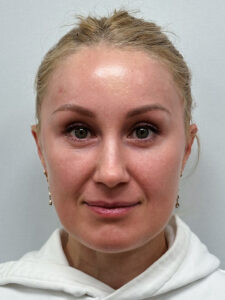 Эндоскопический лифтинг с нижней блефаропластикой и липофилингом в область верхних век - после