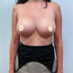Редукционная маммопластика - после