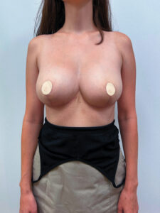 Редукционная маммопластика - после
