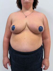 Редукционная маммопластика - после