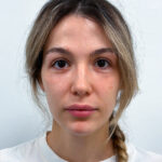 Нижняя блефаропластика - после