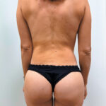 Бодилифтинг - после