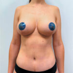 Маммопластика подтяжка + бодилифт - после