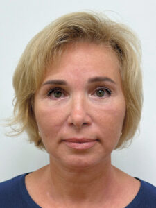 Тотальное омоложение лица - после