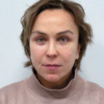 Эндоскопический лифтинг в сочетании с блефаропластикой - после