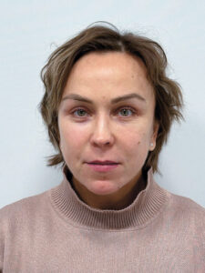 Эндоскопический лифтинг в сочетании с блефаропластикой - после