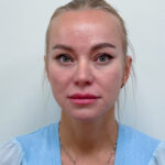 Периорбитальная эндоскопическая бьютификация - после