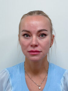 Периорбитальная эндоскопическая бьютификация - после