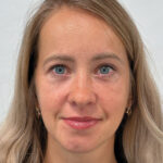 Эндоскопический лифтинг с блефаропластикой - после