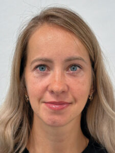 Эндоскопический лифтинг с блефаропластикой - после