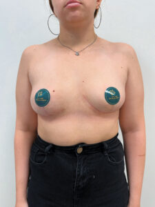 Подтяжка без имплантации + увеличение - после