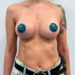 Подтяжка - после