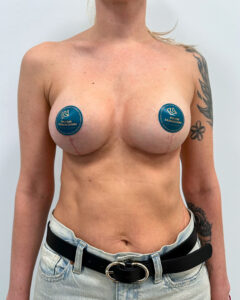 Подтяжка - после