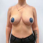 Подтяжка - после