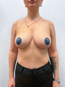 Подтяжка - после