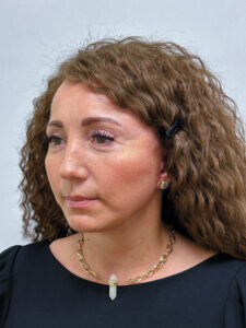 Тотальное омоложение лица - после