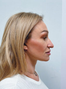 Тотальное омоложение лица - после