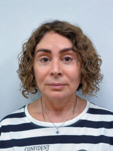 Тотальное омоложение лица - после