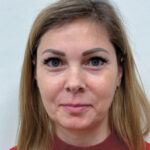 Эндоскопический лифтинг в сочетании блефаропластикой - после