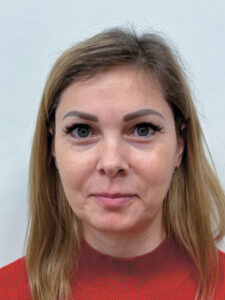 Эндоскопический лифтинг в сочетании блефаропластикой - после