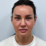 Эндоскопический лифтинг в сочетании блефаропластикой - после