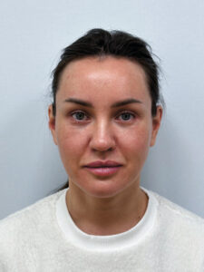 Эндоскопический лифтинг в сочетании блефаропластикой - после