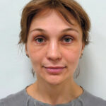 Эндоскопический лифтинг в сочетании блефаропластикой - после