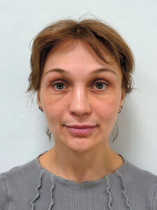 Эндоскопический лифтинг в сочетании блефаропластикой - после