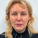 Эндоскопический лифтинг в сочетании блефаропластикой - после