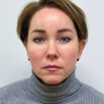 Эндоскопический лифтинг в сочетании блефаропластикой - после