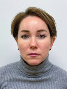 Эндоскопический лифтинг в сочетании блефаропластикой - после