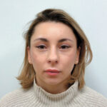 Эндоскопический лифтинг в сочетании блефаропластикой - после