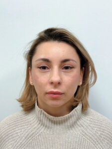 Эндоскопический лифтинг в сочетании блефаропластикой - после