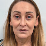 Эндоскопический лифтинг в сочетании блефаропластикой - после