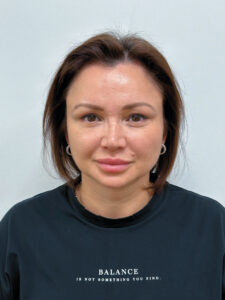 Эндоскопический лифтинг в сочетании блефаропластикой - после