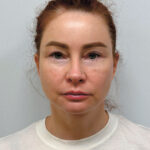 Эндоскопический лифтинг в сочетании блефаропластикой - после