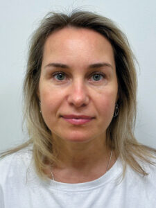 Эндоскопический лифтинг в сочетании блефаропластикой - после