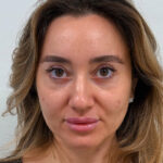 Эндоскопический лифтинг с нижней блефаропластикой - после