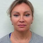 Комплексное омоложение лица - после