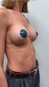 Маммопластика увеличение - после