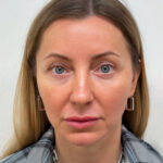 Трансконъюнктивальная блефаропластика - после