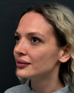 Ринопластика - после