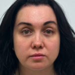 Эндоскопический лифтинг с блефаропластикой - после