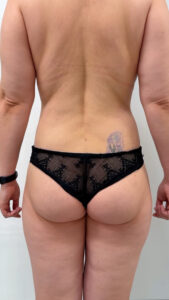 Липосакция - после