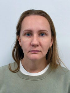 Эндоскопический лифтинг + круговая блефаропластика - после