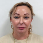 Тотальное омоложение лица - после