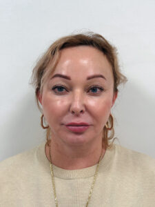 Тотальное омоложение лица - после